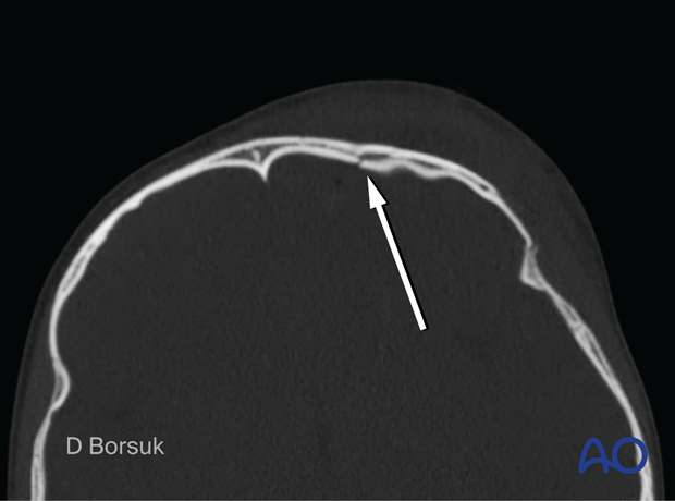 CT scan slice showing the absence of the frontal sinus with depressed skull/orbit fracture in a pediatric patient.