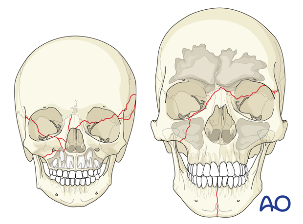 Pediatric versus adult craniomaxillary fractures.