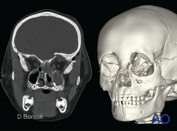 CT scan slice and 3D reconstruction showing a Le Fort III, skull base, mandible, orbital roof fracture in a 4-year-old patient.