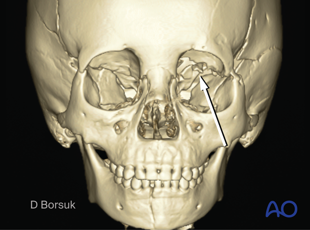 3D CT reconstruction showing a Le Fort III, skull base, mandible, orbital roof fracture in a 4-year-old patient.