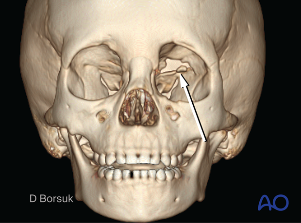 3D CT reconstruction showing fracture remodeling of the Le Fort III and mandible fractures in a pediatric patient.