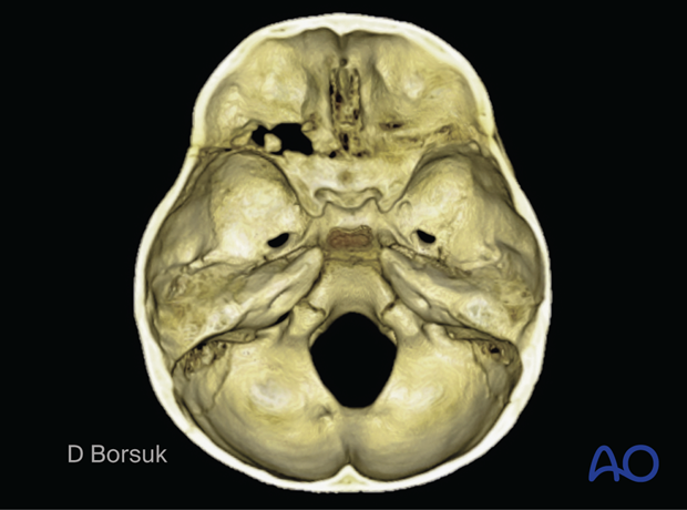 3D CT reconstruction showing a left orbital roof growing skull fracture in a pediatric patient.