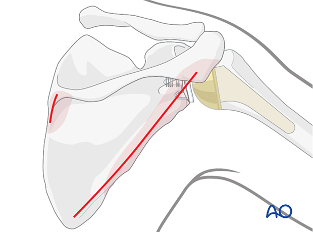 The Brodsky approach may be combined with a limited incision over the medial end of the scapular spine to control a medial border exit fracture line.