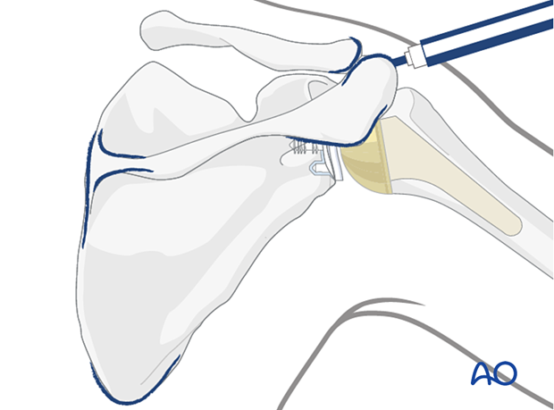 Marking anatomical landmarks