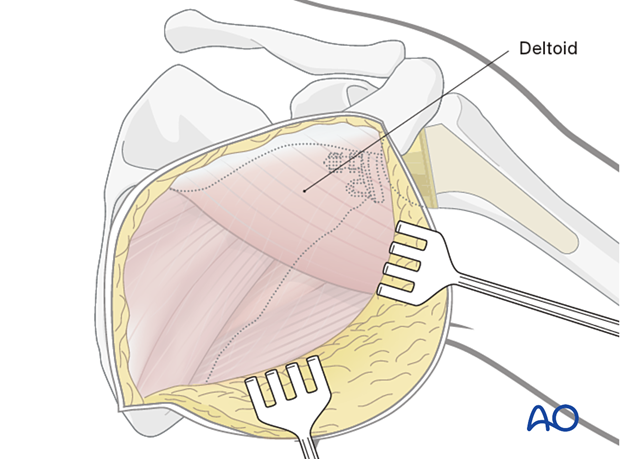 The skin is elevated at the epifascial level, just enough to expose the inferior border of the deltoid muscle.