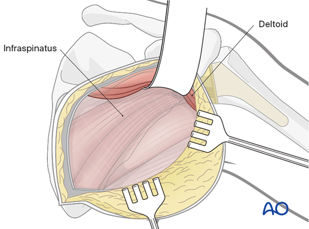 Modified Judet approach