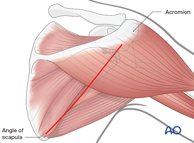 Lateral column approach (Brodsky approach to the scapula)