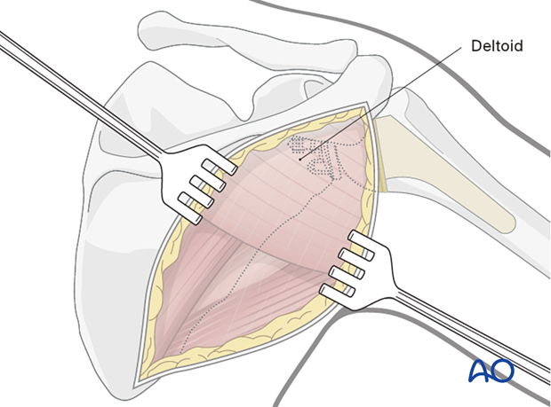 The skin is elevated at the epifascial level enough to expose the inferior border of the deltoid muscle.