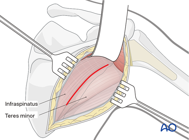 The deltoid muscle is retracted superiorly after incising the fascia over the inferior border of the muscle.