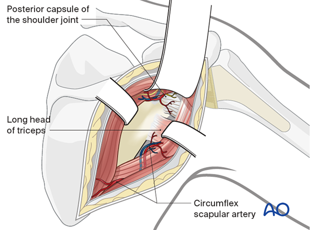 The long head of the triceps is exposed laterally