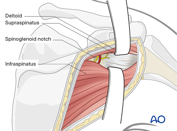 Exposure of the superior part of the articular segment and glenoid rim can be performed through the interval between the supraspinatus and infraspinatus. Care must be taken to avoid injury of the nerves to the infraspinatus at the spinoglenoid notch.