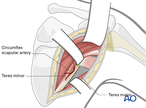 The interval between teres minor and teres major is identified by exposure of the circumflex scapular vessels.