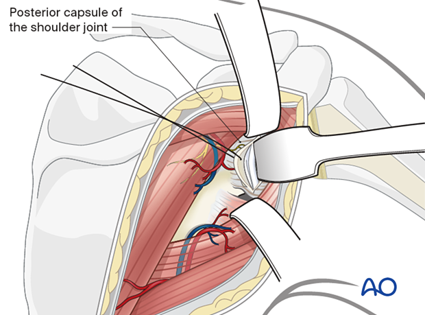 A transverse posterior glenohumeral arthrotomy exposes the glenoid fossa when checking for intra-articular fracture reduction and inadvertent penetration of the joint surfaces by fixation screws.