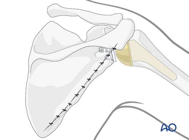 Wound closure