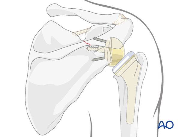 Scapula and humerus with prostheses