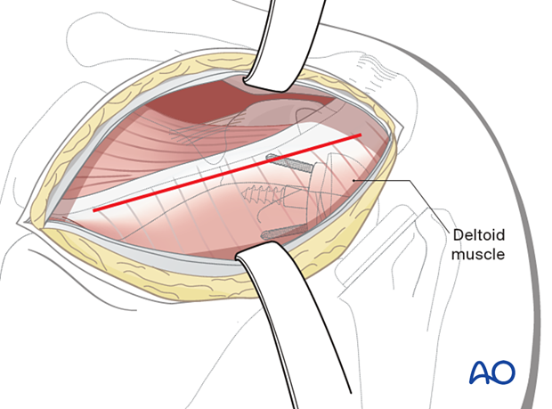 Using sharp dissection, divide the deltoid from its insertion into the scapular spine and base of the acromion.