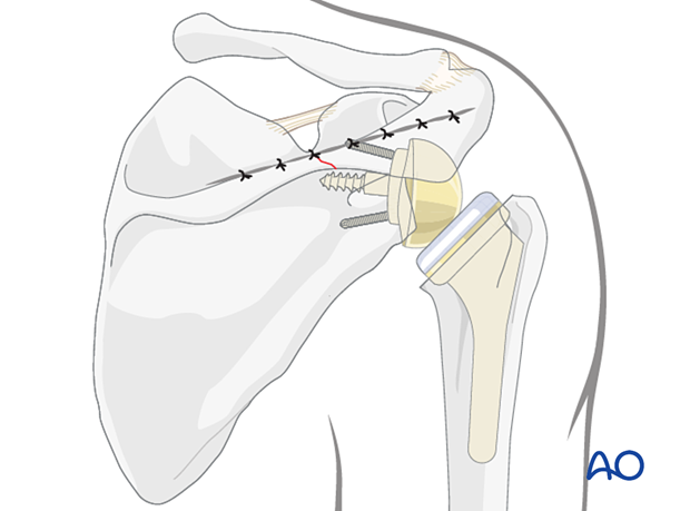 Wound closure