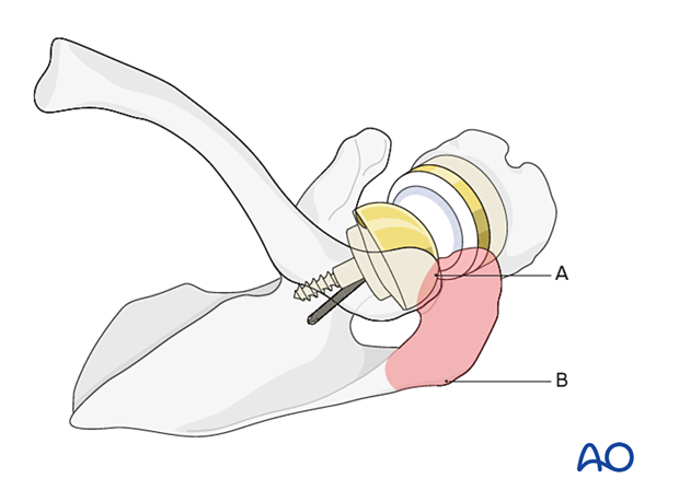 The superior acromial anterior to posterior approach (or Sabercut approach) – anatomical landmarks