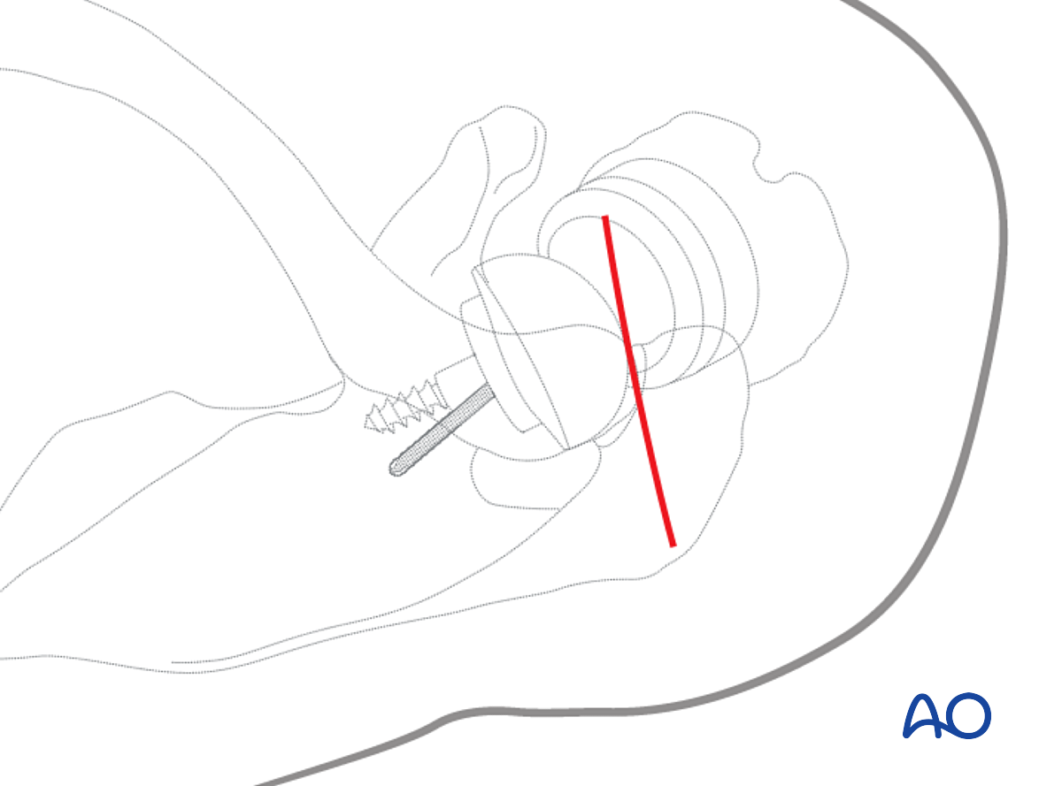 Superior Acromial Anterior To Posterior Approach (Sabercut Approach)