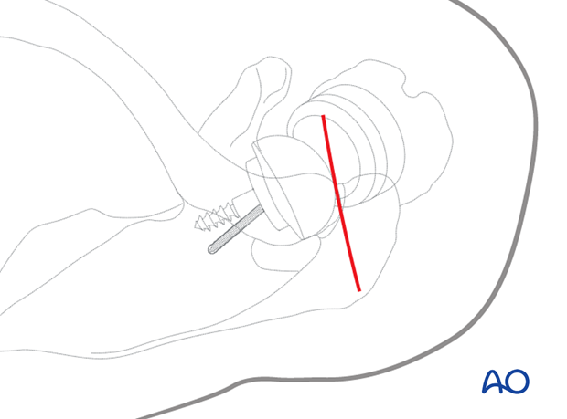 The superior acromial anterior to posterior approach (or Sabercut approach) – skin incision