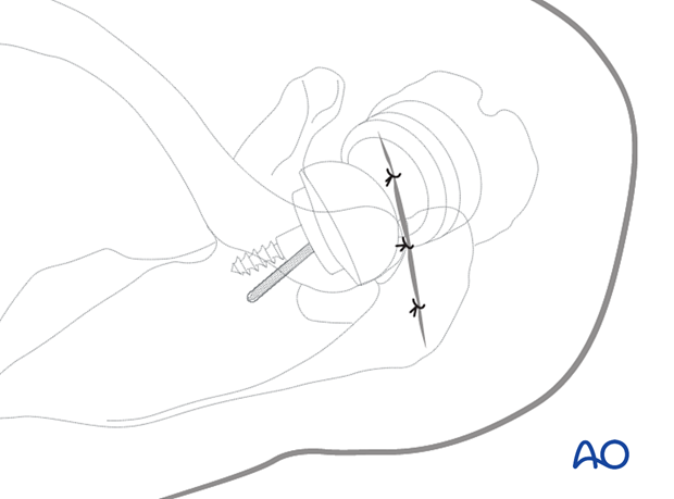 The superior acromial anterior to posterior approach (or Sabercut approach) – wound closure