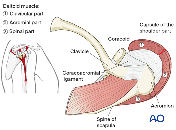 Superior scapular approach - the incision is placed between the clavicular part (1) and the acromial part (2) of the deltoid muscle 