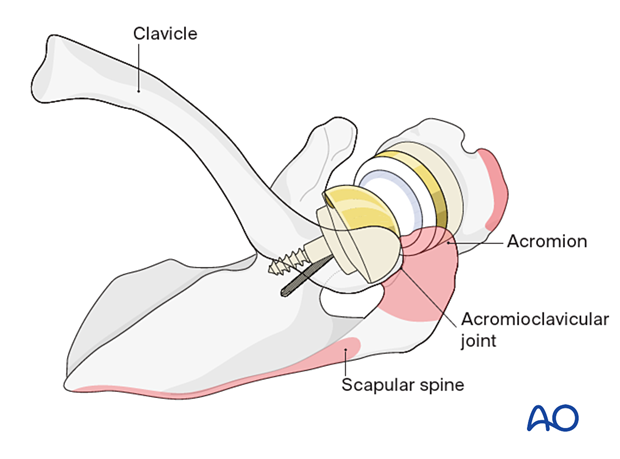 Superior scapular approach - anatomical landmarks