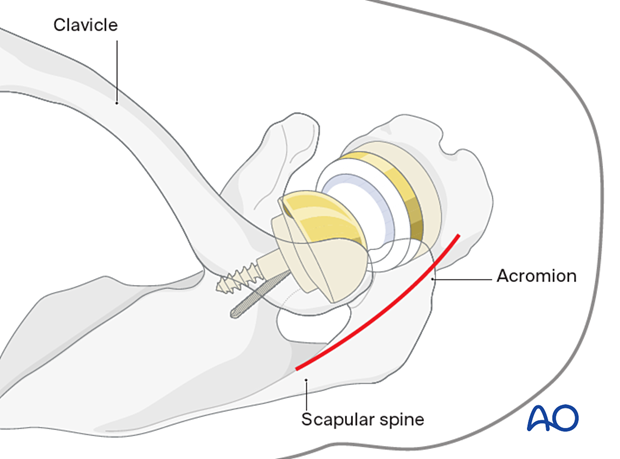 Superior scapular approach - skin incision