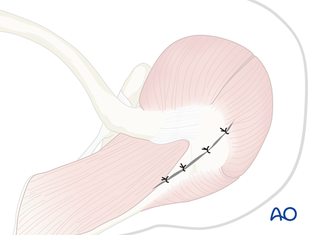 Superior scapular approach - wound closure