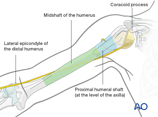 Deltopectoral approach - anatomical landmarks for skin incision