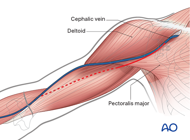 Deltopectoral approach – skin incision