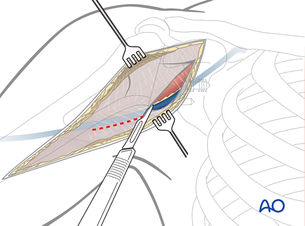 Deltopectoral approach – exposure of the superficial fascia