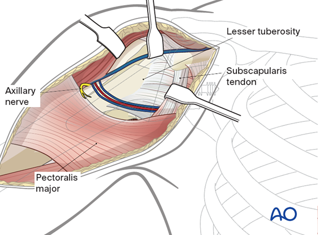 Deltopectoral approach – the deltoid muscle is retracted laterally and the conjoint tendon is retracted medially.