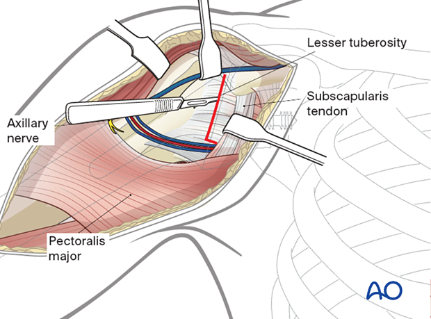 Deltopectoral approach – the subscapularis tendon is mobilized and reflected