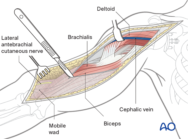 Distal extension of the deltopectoral approach 