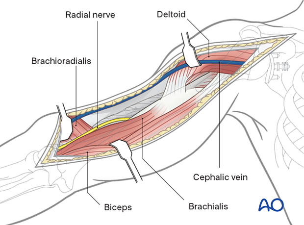 Distal extension of the deltopectoral approach - the biceps is retracted medially and the brachioradialis laterally.