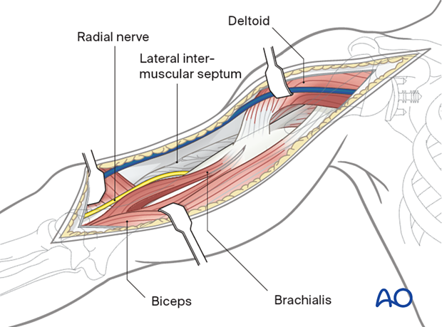 Distal extension of the deltopectoral approach - deep dissection