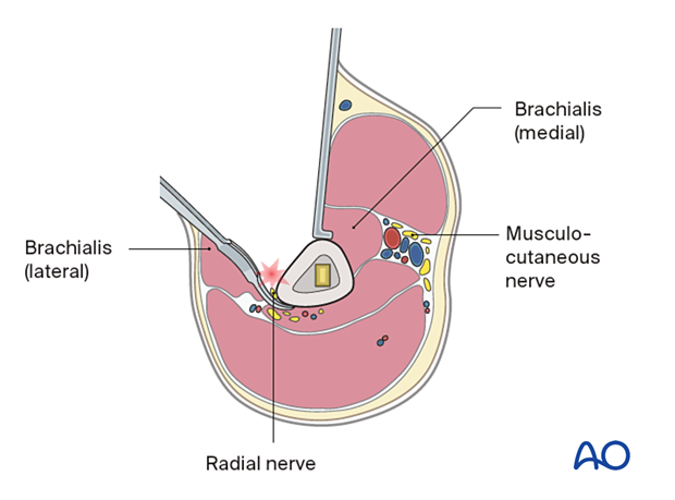 Distal extension of the deltopectoral approach - the radial nerve enters the anterior compartment by perforating the lateral intermuscular septum. The use of Hohmann retractors in the distal 2/5 of the humerus carries a high risk of iatrogenic nerve injury and should therefore be avoided.