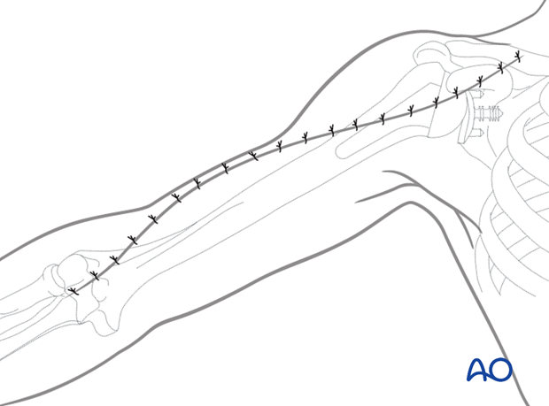 Distal extension of the deltopectoral approach - wound closure