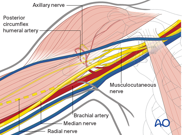 Deltopectoral approach – exposure of the brachial plexus