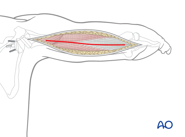 Posterior humeral approach - superficial dissection