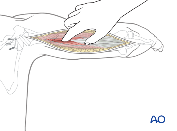 Posterior humeral approach – deep dissection