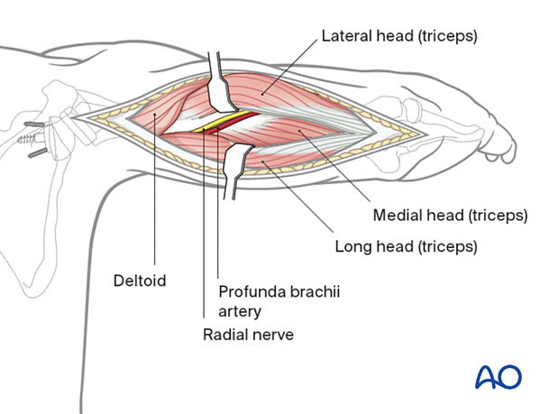 Posterior humeral approach – the radial nerve and accompanying profunda brachii artery are identified proximal to the medial head of the triceps in the spiral groove.