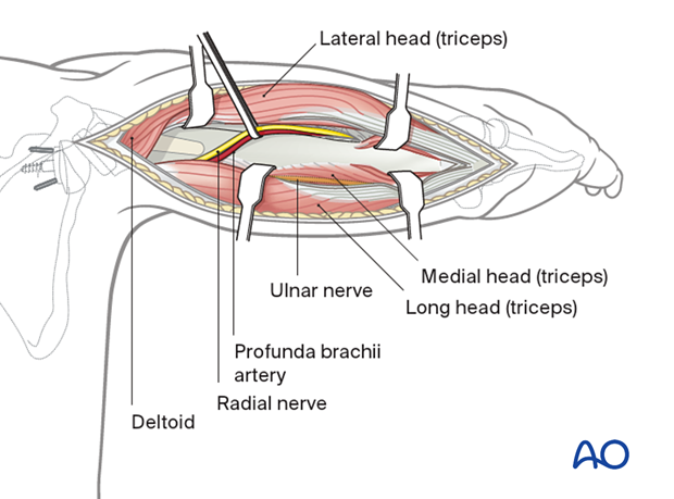 Posterior humeral approach – the triceps tendon and muscle are split distally by sharp dissection.