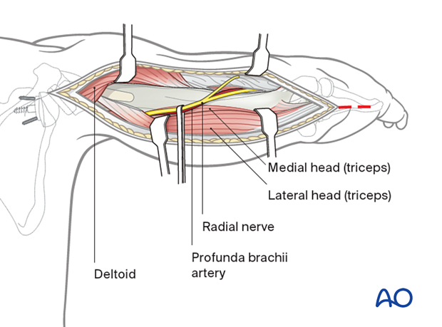 Posterior humeral approach – distal extension