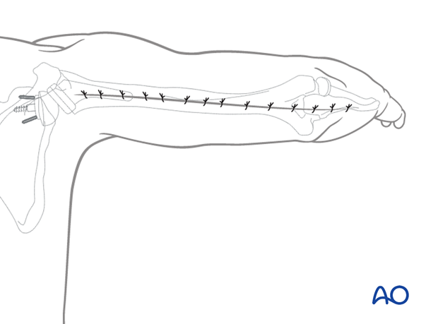 Posterior humeral approach – wound closure