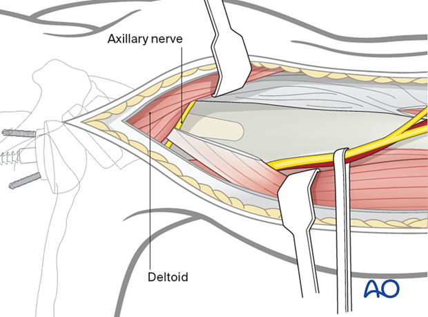 per 10 A180 Posterior humeral approach