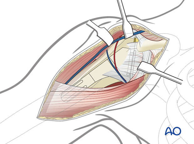 Humeral osteotomy - approach