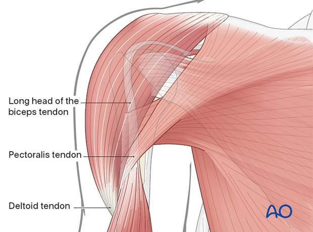 Humeral osteotomy - deep approach