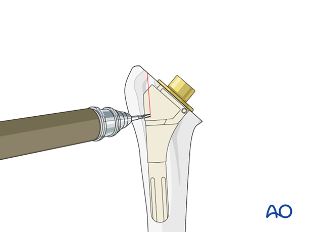 Humeral osteotomy – a microsaw is used to cut straight down to the implant